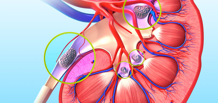 Review Of Kidney Stone Removal Report By Joe Barton